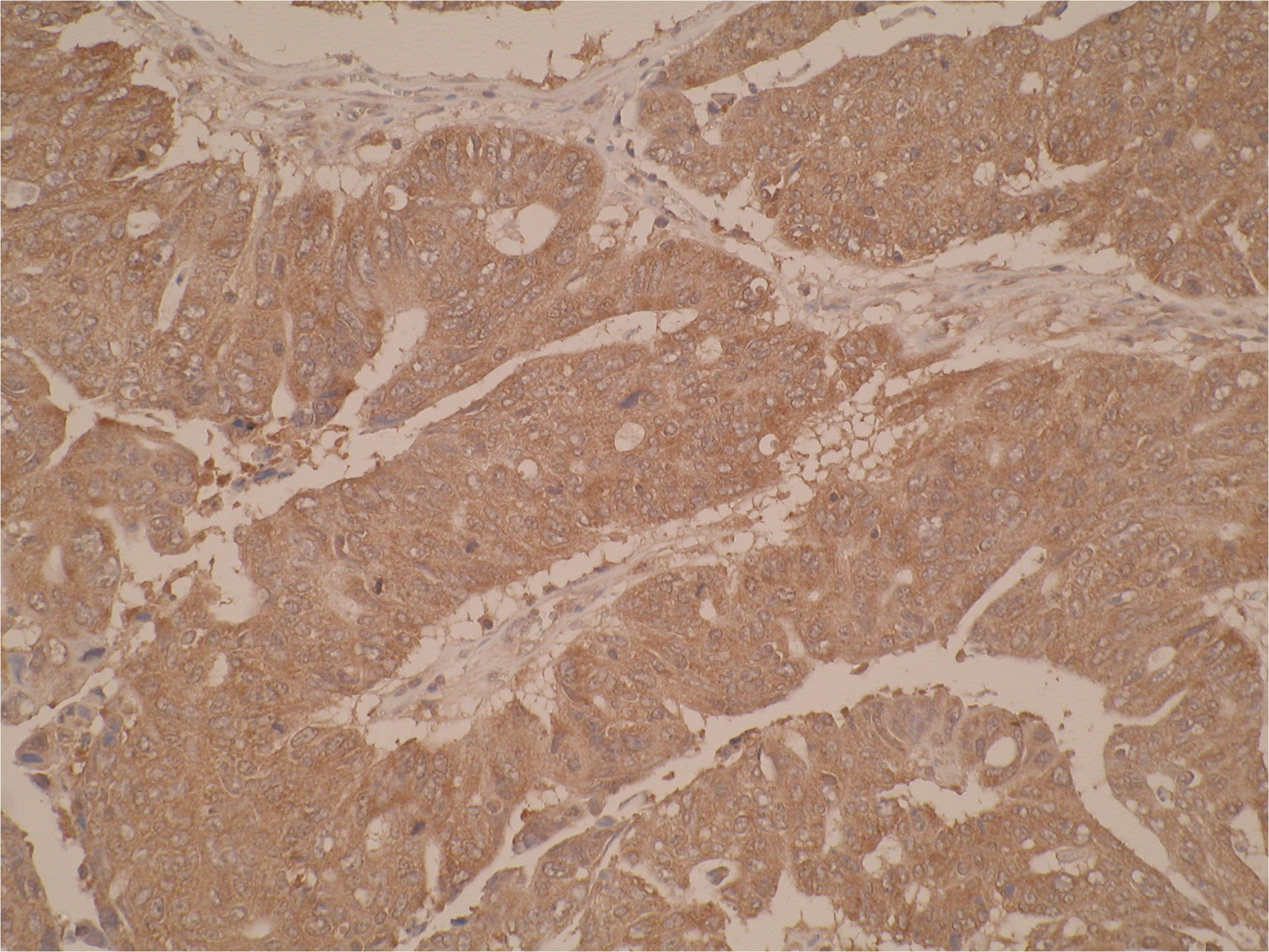Immunohistochemistry was performed using formalin-fixed, paraffin-embedded tissue sections of human colon carcinoma using anti-Cytochrome P450 2W1 [V32-P5E5]. Strong cytoplasmic staining is shown as expected. The antibody showed no or weak staining in another non-cancerous tissue (data not shown).