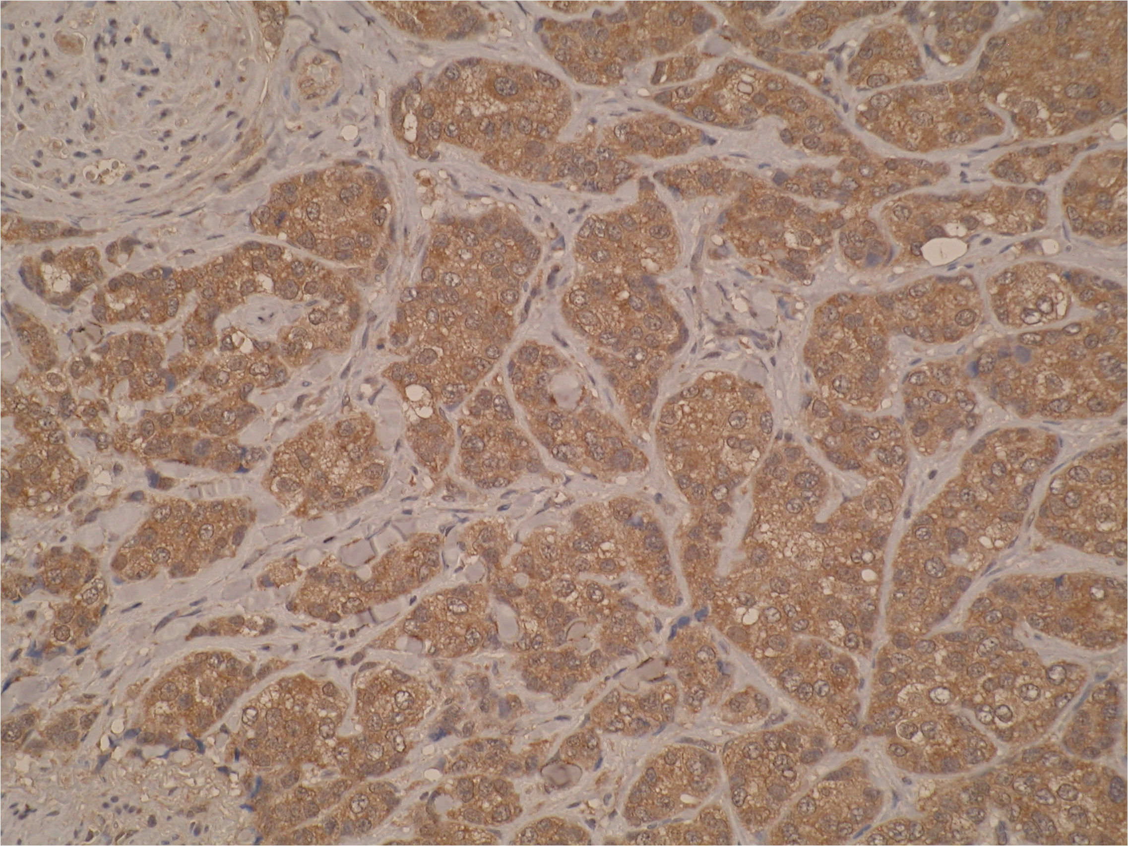 Immunohistochemistry was performed on formalin-fixed, paraffin-embedded tissue sections and showed strong cytoplasmic immunostaining in breast cancer tissue. 
