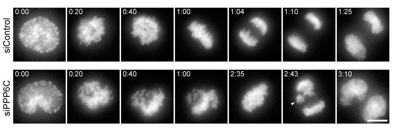 ©2010 Zeng et al. J Cell Biol. Dec 27;191(7):1315-32. doi: 10.1083/jcb.201008106.  
HeLa cells stably expressing EGFP-tagged histone H2B were transfected with control or protein phosphatase 6 catalytic subunit (PPP6C) si08 duplexes for 48 h and then imaged. An image stack of 25 planes spaced 0.7 μm apart was taken at four stage positions every minute for 10–12 h. Exposure times were 10 ms for EGFP-tagged histone H2B using 1% of full lamp intensity. A brightfield reference image stack was also collected using 10-ms exposures. Arrowhead marks abnormal spindle pole and lagging chromosomes. Bar, 10 μm.

