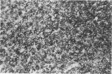 Adapted from Murray LJ, Dhut S, Walker LC, Rainey M, Habeshaw JA. Two monoclonal antibodies raised against a Burkitt lymphoma cell line recognise different cell types within lymphoid follicles. Clin Exp Immunol. 1985 Feb;59(2):315-26. PMID: 3872187; PMCID: PMC1577118. B-CLL with 35.1C5. All cells are strongly positive. Magnification x 125.