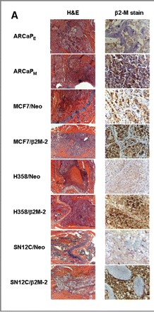 Adapted from Josson et al. 2011. Cancer Res. 71(7):2600-10. PMID: 21427356. Figure A, histomorphology (left) and immunohistochemical staining of β2-M (right) in metastatic bone induced by intracardiac injections of ARCaP subclones and Neo and β2-M overexpressing clones of MCF7, H358, and SN12C in nude mice.