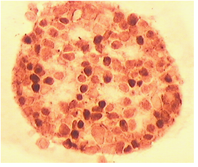 MCF-7/S0.5 cells stained for oestrogen receptor expression 